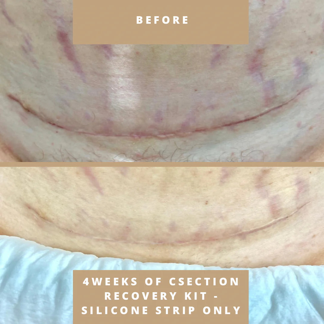 Csection Scar Recovery Kit 2.0